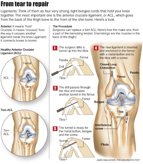 ACL repair infographic for the washington post by James Smallwood